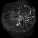 Racemose Angioma Racemose Angioma