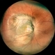 Choroidal Tubeculoma