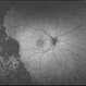 Familial Exudative Vitreoretinopathy Familial Exudative Vitreoretinopathy