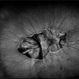 Macular Dystrophy Macular Dystrophy