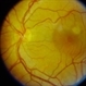 Central Serous Chorioretinopathy (CSR)