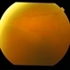 Bilateral Senile Retinoschisis