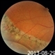 Pigmented Demarcation Line and  Retinal Macrocyst Pigmented Demarcation Line and  Retinal Macrocyst