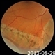 Pigmented Demarcation Line and  Retinal Macrocyst Pigmented Demarcation Line and  Retinal Macrocyst