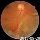 Pigmented Demarcation Line and  Retinal Macrocyst Pigmented Demarcation Line and  Retinal Macrocyst