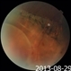 Pigmented Demarcation Line and  Retinal Macrocyst Pigmented Demarcation Line and  Retinal Macrocyst