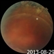 Pigmented Demarcation Line and A  Blood - containing Retinal Macrocyst