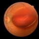 Primary Subhyaloid Hemorrhage Due to Valsalva Retinopathy Primary Subhyaloid Hemorrhage Due to Valsalva Retinopathy