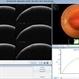 Primary Subhyaloid Hemorrhage due to Valsalva Retinopathy Primary Subhyaloid Hemorrhage due to Valsalva Retinopathy