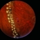 Angioma from Chronic Retinal Detachment Angioma from Chronic Retinal Detachment