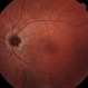 Melanocytoma of Optic Disc Melanocytoma of Optic Disc