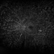 Proliferative Diabetic Retinopathy with Diabetic Macular Edema Proliferative Diabetic Retinopathy with Diabetic Macular Edema