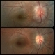 Pseudotumor cerebri