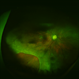 Post-Endophthalmitis Retinal Detachment and Retinal Necrosis