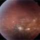 Ocular Toxoplasmosis Ocular Toxoplasmosis