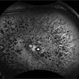 Retinitis Pigmentosa