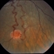 Retinal  Angiomas In VHL