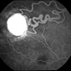 Retinal  Angiomas In VHL