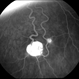 Retinal  Angiomas In VHL