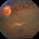 Retinal  Angiomas In VHL