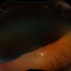 Ciliary Body Melanoma Ciliary Body Melanoma