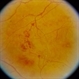 Neovascularisation elsewhere (NVE)