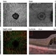Full Thickness Macular Hole Full Thickness Macular Hole