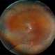 Lattice Degeneration With Atrophic Retinal Holes Lattice Degeneration With Atrophic Retinal Holes
