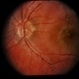 CGD / Chronic Granulomatous Disease