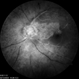 Central Retinal Artery Occlusion with Cilioretinal sparing Central Retinal Artery Occlusion with Cilioretinal sparing