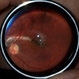 Scar after traumatic choroidal rupture