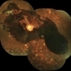 Preretinal Bleed in Lasered PDR Preretinal Bleed in Lasered PDR
