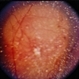 Choroidal Melanoma With Vitreous Seeding Choroidal Melanoma With Vitreous Seeding