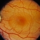 Central Serous Chorioretinopathy (CSR)