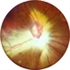 Extensive Myelinated Nerve Fibres Extensive Myelinated Nerve Fibres