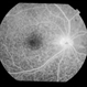 Uveitis With Exudative Retinal Detachment