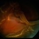 Retinal Detachment