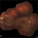 Treated Retinal Tear