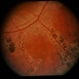 CGD / Chronic Granulomatous Disease