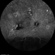 Multifocal Exudative Detachments Due to VKH Multifocal Exudative Detachments Due to VKH