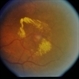 BDR / Macular Edema / Macroaneurysm BDR / Macular Edema / Macroaneurysm