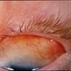Linear Nevus Sebaceous Syndrome Linear Nevus Sebaceous Syndrome