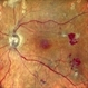 Proliferative Diabetic Retinopathy Proliferative Diabetic Retinopathy