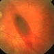 Macular Hemorrhage After Scleral Buckling Macular Hemorrhage After Scleral Buckling