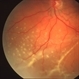 Retinal Detachment and Proliferative Vitreoretinopathy Retinal Detachment and Proliferative Vitreoretinopathy
