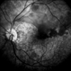 Branch Retinal Artery Occlusion With Calcium Embolus at the Disc - Fundus  Fluorescence Angiogram (FA) Branch Retinal Artery Occlusion With Calcium Embolus at the Disc - Fundus  Fluorescence Angiogram (FA)