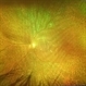 Post-op Vitreous Surgery