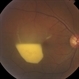 Retrohyaloid Hemorrhage Resolving 2016-05-01 Retrohyaloid Hemorrhage Resolving 2016-05-01
