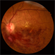 Branch Retinal Vein Occlusion Branch Retinal Vein Occlusion