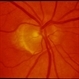 Adult Foveomacular Dystrophy / Pattern Adult Foveomacular Dystrophy / Pattern
